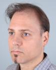 Before Hair Transplant&nbsp;Revision